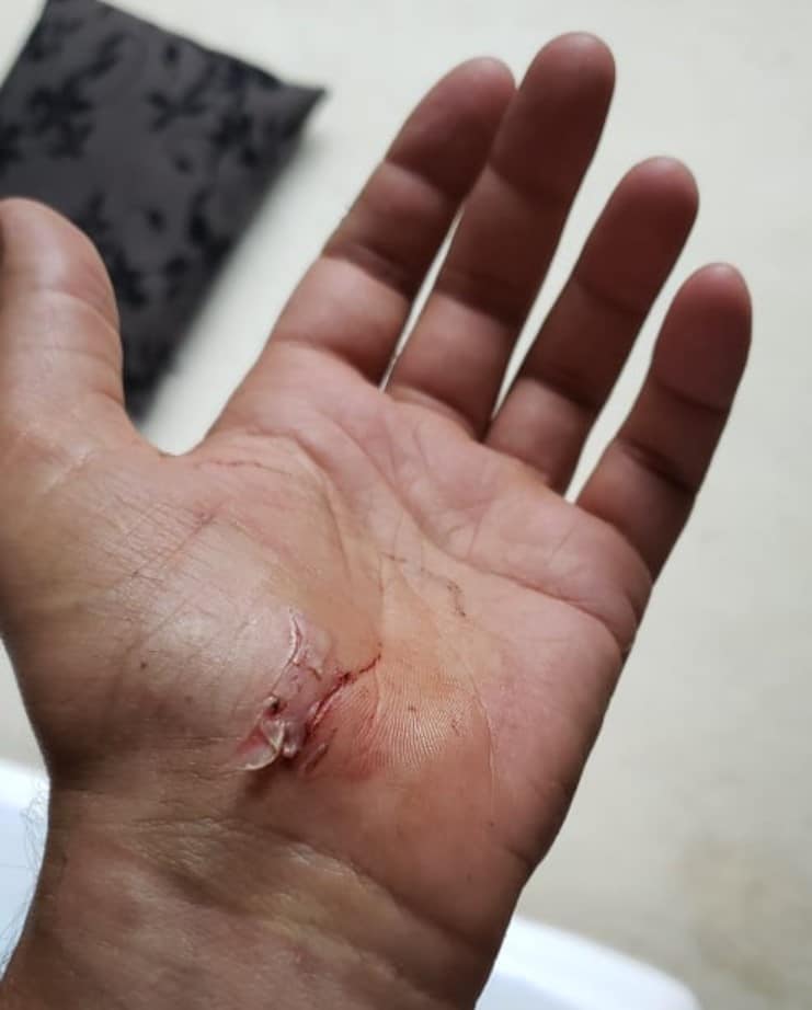 mini chainsaw injury hand
